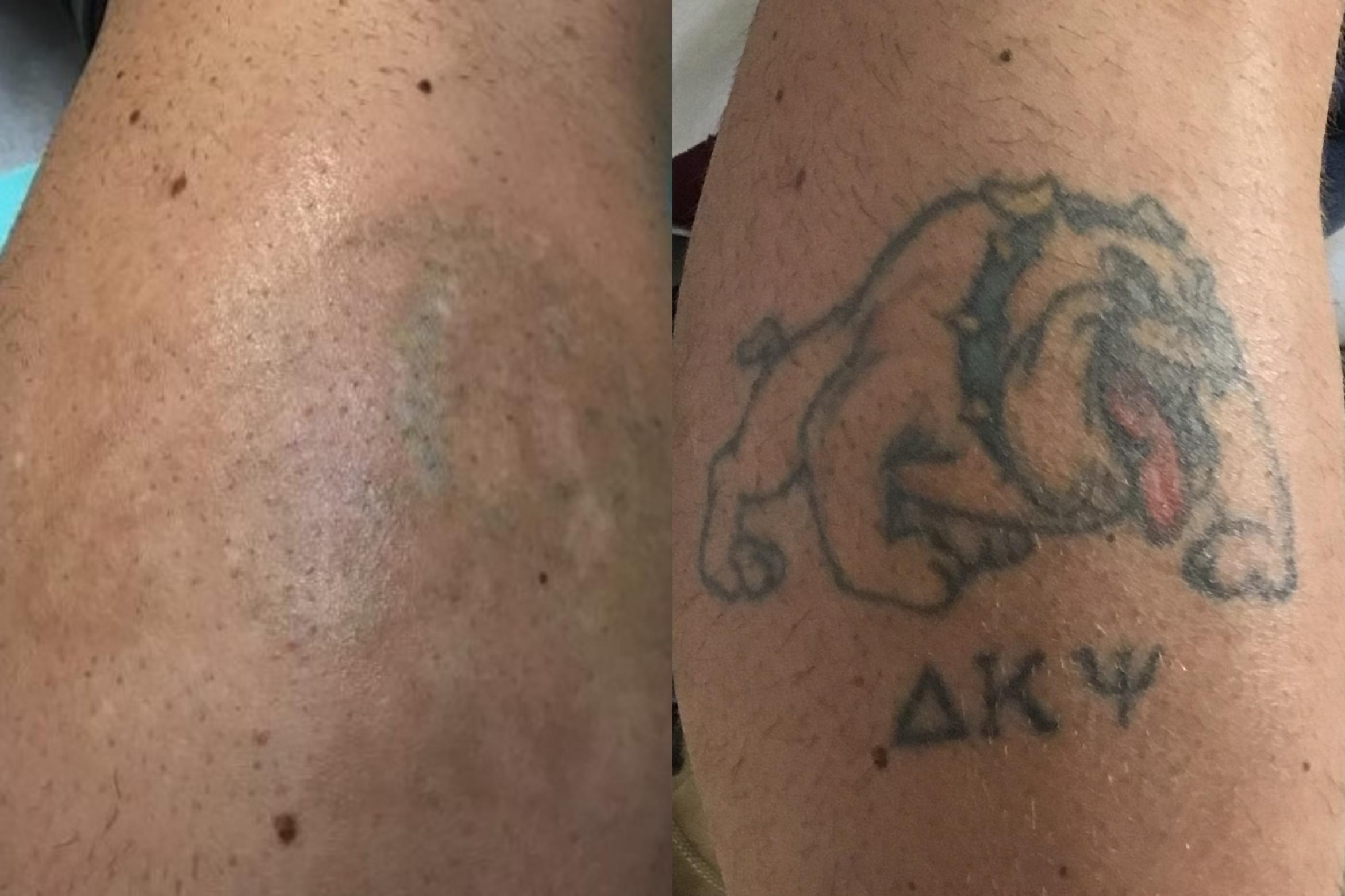 Tattoo removal progress pics 🌈 Laser Tattoo Removal - Full E